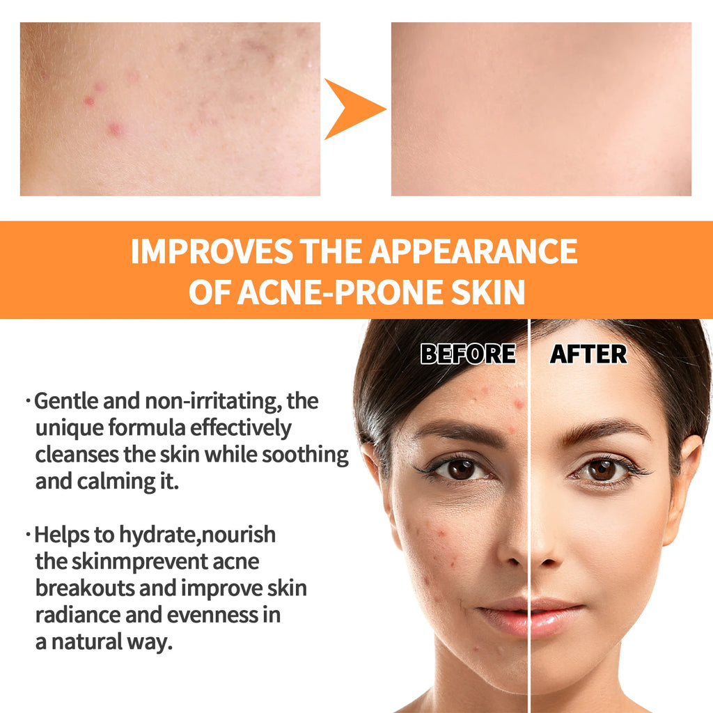 EELHOE Crema facial, sérum, aceite, mascarilla corporal, blanqueadora, antiacné, aclara manchas oscuras e hidratante.
