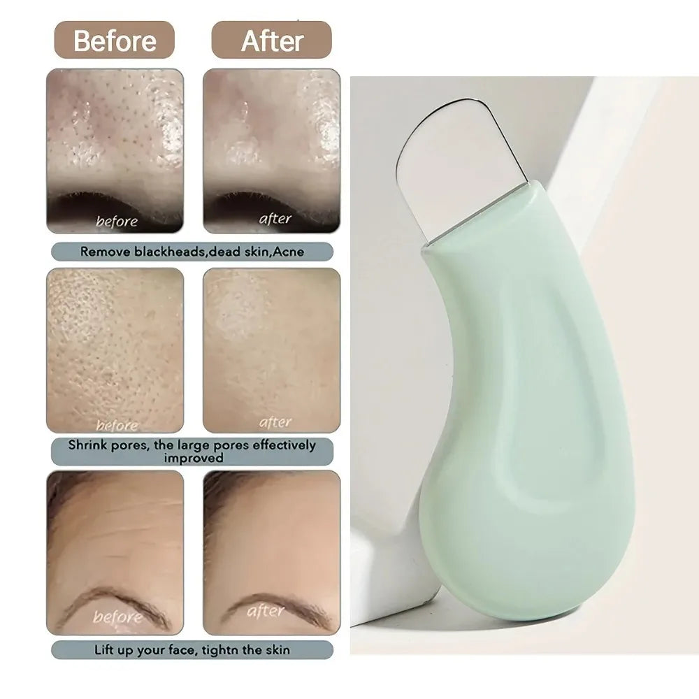 Herramienta para eliminar puntos negros y espinillas en la nariz y el rostro - Limpiador de poros y herramientas para el cuidado de la piel para mujeres